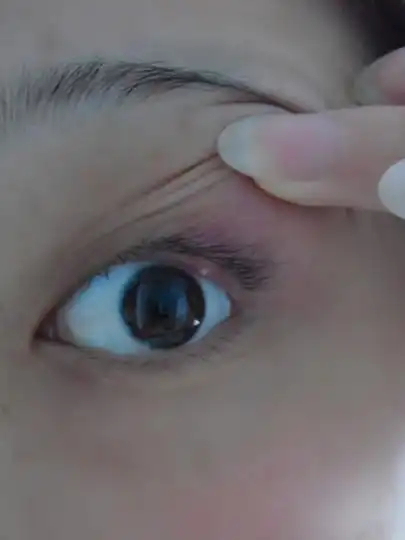 医生帮忙看看这个麦粒肿吗?需要去医院吗?