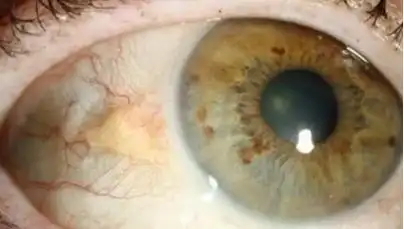 工作中常年面对电脑得了睑裂斑该怎么去除-眼睛红血丝_眼球红血丝