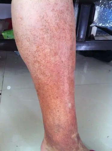 50多岁老人脚踝到小腿处长了一大片红褐色的斑,这是什么皮肤病?