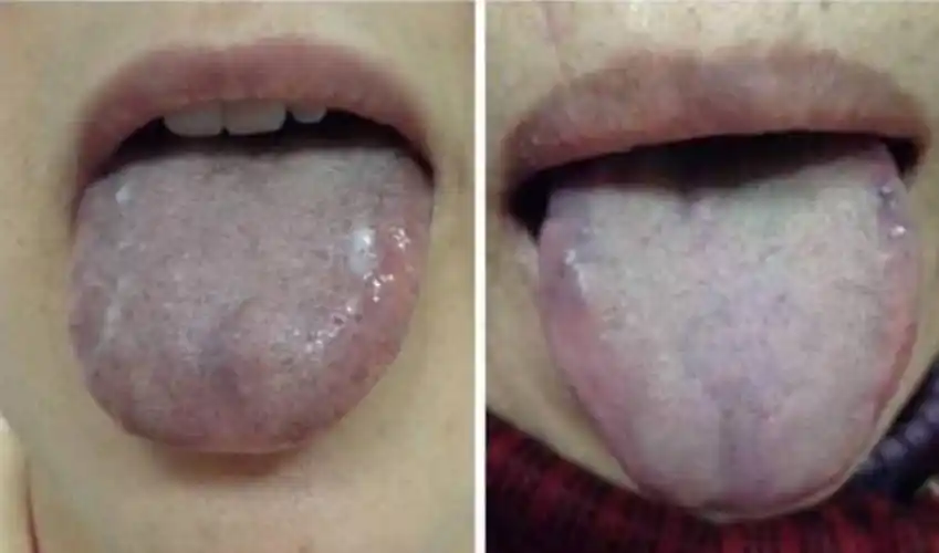 (血瘀质舌头最明显的特点:舌质暗有瘀点,瘀斑)体质类型会影响人的代谢