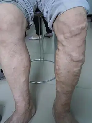 泉州成功医院 - 静脉曲张特诊