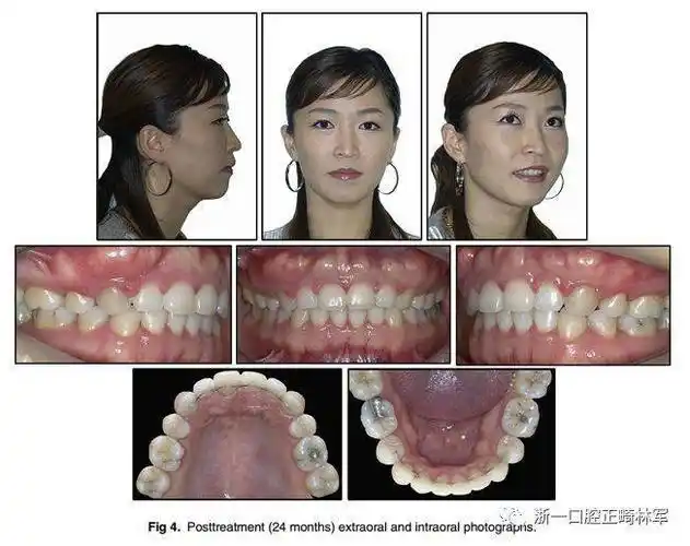 病例分享双牙槽突前突用微螺钉内收前牙一例