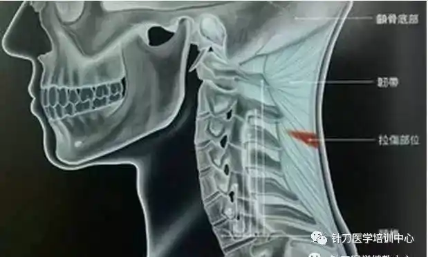 干货| 针刀治疗韧带损伤篇(颈,腰,膝)
