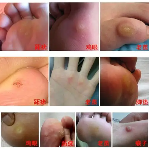 鸡眼和跖疣是什么原因引起的 怎样去除鸡眼和跖疣