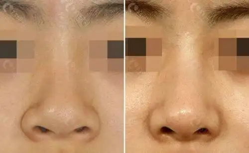 鼻翼缩小前后对比