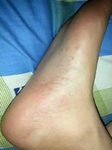 脚上起的小红疹