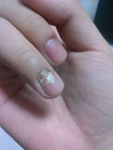 就这一个手指头指甲变形了,怎么回事啊?