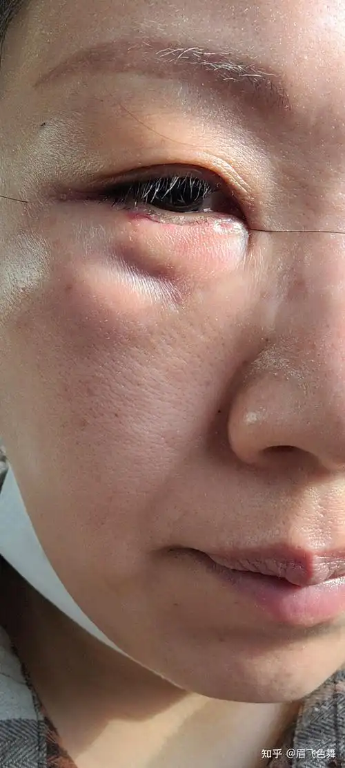 外切眼袋手术第二天,左边眼睛有个坑不知道是不是正常的好担心 - 知乎