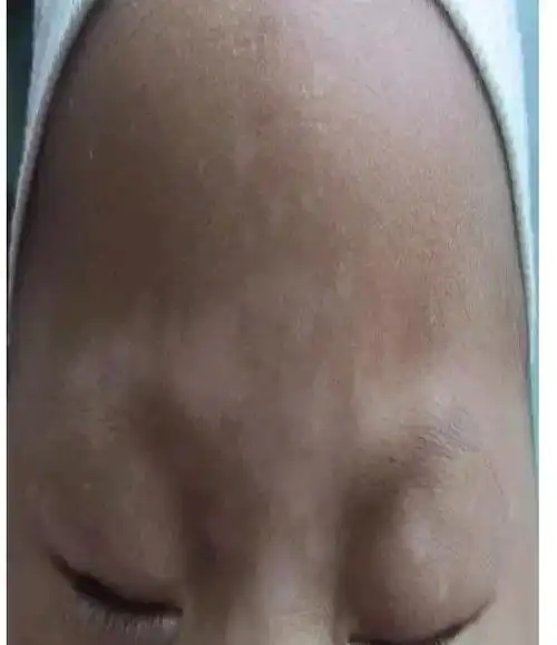 无色素痣图片发自160医生app1313无色素痣常出生时或出生不久出现