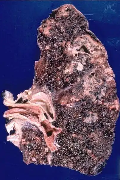 继发性肺结核的治疗方法?