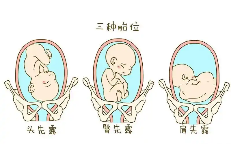胎儿横位姿势图
