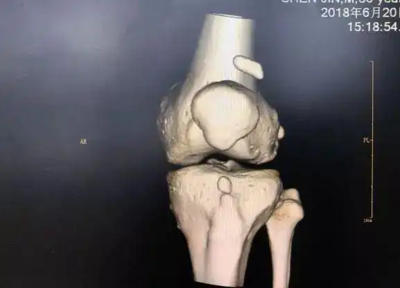 膝关节游离体游离里的秘密游离体常见于多个关节:临床上发生游离体的