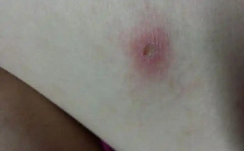 女性全部图片一期梅毒是不是这个的图片一期梅毒的手腕的表现图片一期