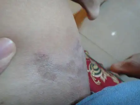 大腿根部内侧股癣