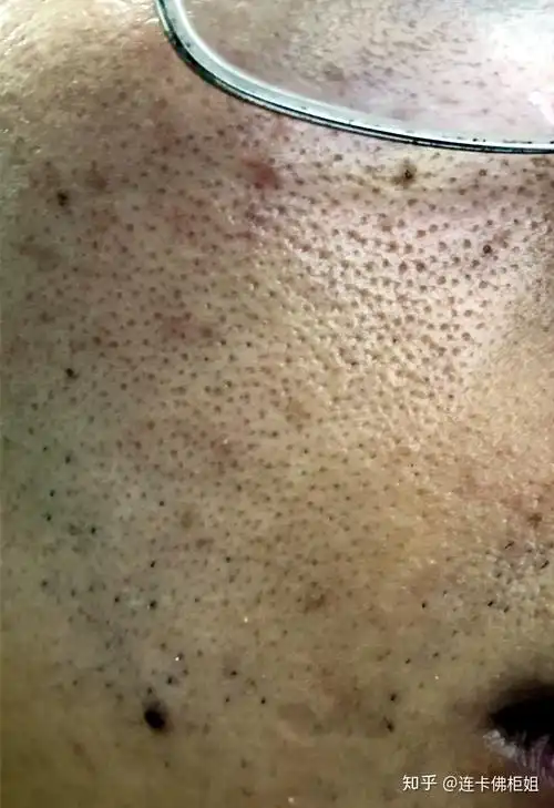 我想知道,去黑头最有效的解决办法是什么,我脸上的黑头毛孔都要难看死