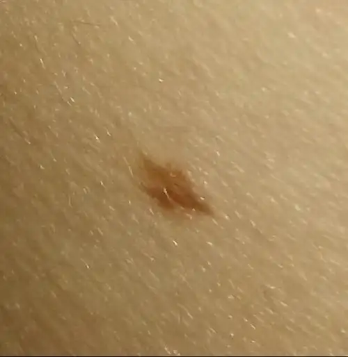 最近发现胸部下方长了一颗痣,有没有危险,需不需要切除,谢谢.