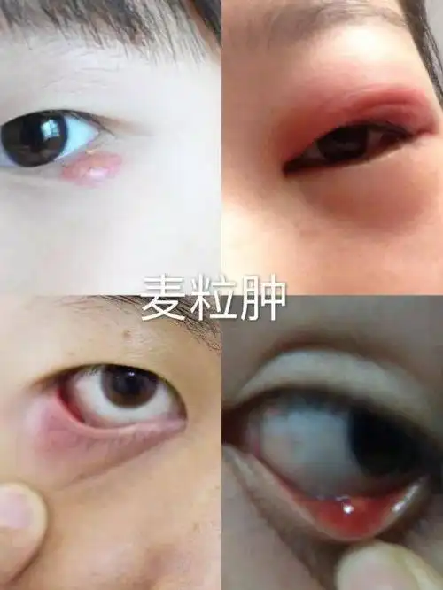 【健康科普】"偷针眼"大百科