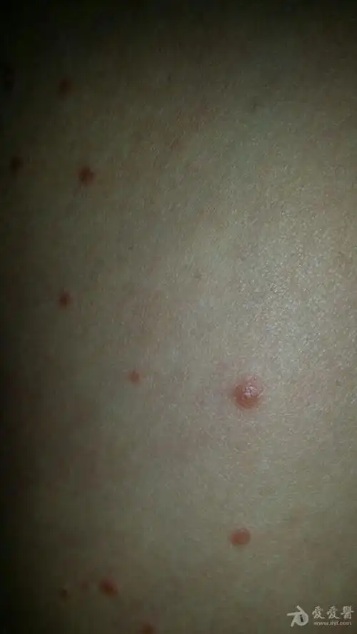 皮肤病有奖病例讨论4———点状银屑病