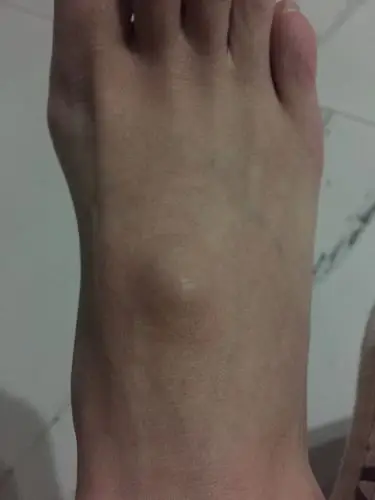 脚背长个硬疙瘩 不痛不痒 是什么情况 怀孕的时候发现的 以为生了宝宝