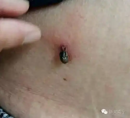 又是这个虫子至多人死亡,这虫子咸宁也很多,大家一定要注意!