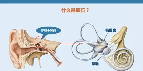 "耳石症"你知道如何康复吗?