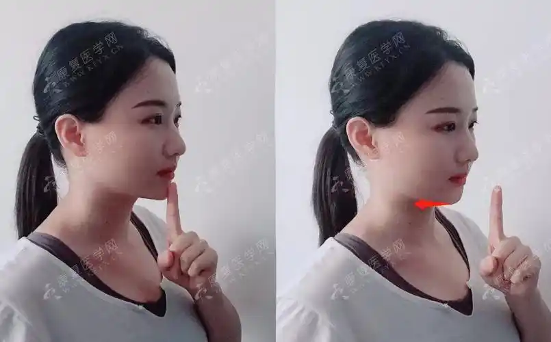 斜方肌紧张颈后大包上交叉综合征造成虎背熊腰的原因都在这了