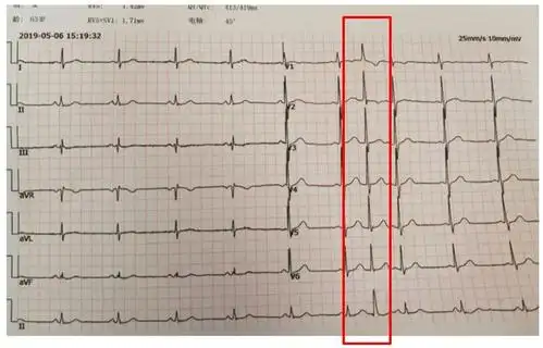 心脏疾病的出现率就比较高,很多人有室性早搏的问题,需要做好心电图
