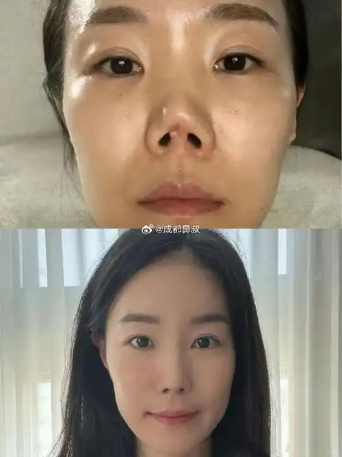 鼻修复五次,男朋友说再整容就和我分手