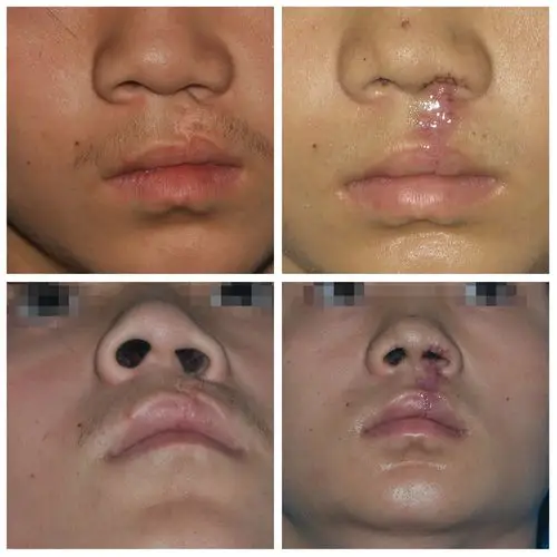 包冰医生唇裂术后继发畸形案例2012年