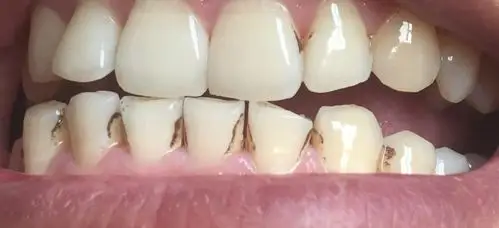 牙菌斑怎么根治?