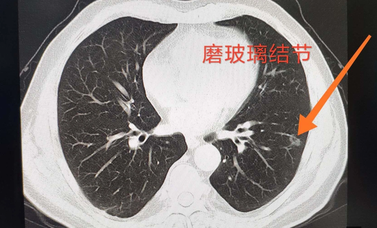 肺部结节和肺部肿瘤是一个东西,只是大小不一样罢了.