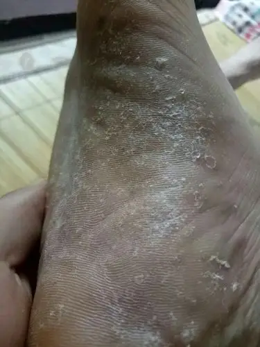 我的脚底痒,天天痒的受不了,请问这是脚气还是脚癣啊?