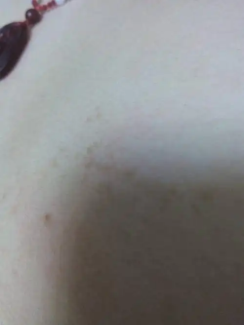 我儿子胸部从小有几块褐色的斑点,随着年龄的增长也跟着长,好像还多了