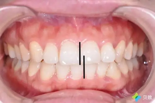 但是,她存在牙中线不齐的情况.