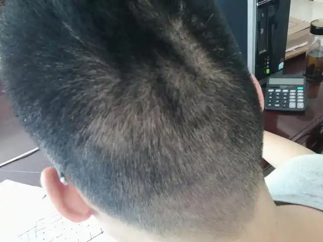 有三四年了之前没有脑后竖向三条棱不痛不痒手摸头皮凹凸