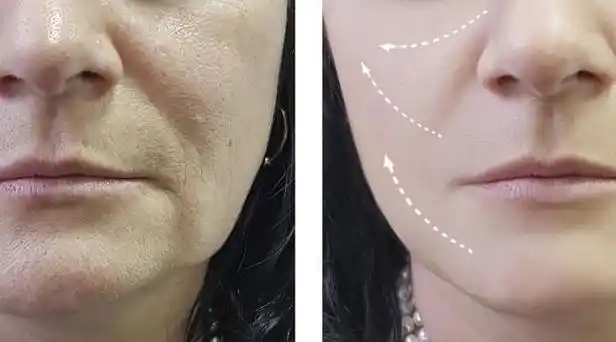 面部筋膜提升术多长时间修复好