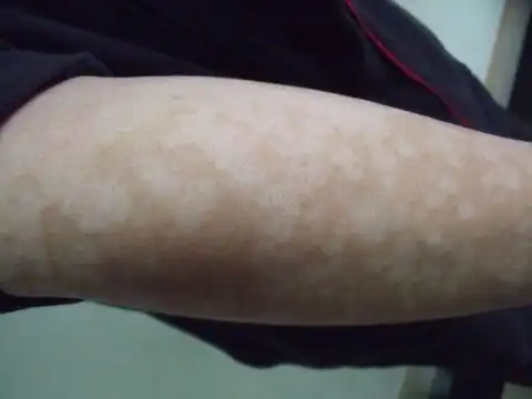 花斑癣:是由马拉色菌感染引起,好发于胸,背,腹和肢体,面,头皮和生殖器