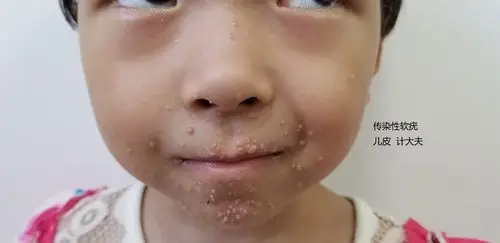 传染性软疣 - 好大夫在线