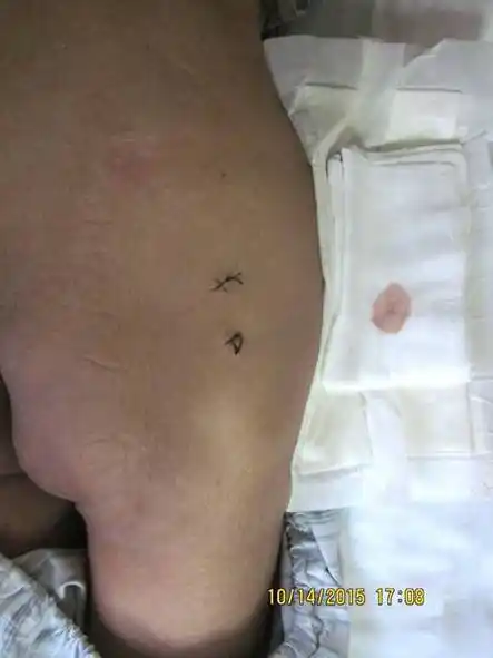 前体位臀肌挛缩症在青少年人群中多发,多数由幼年臀部反复注射史导致