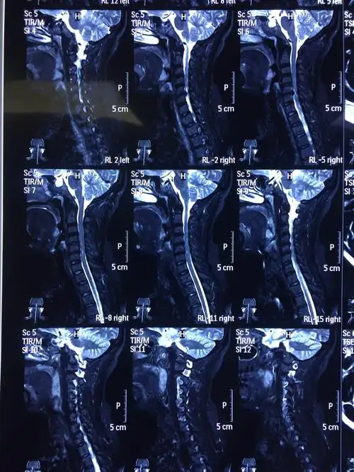 周三待术?脊髓型颈椎病