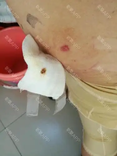上面是胸的样子,下面是腿后抽脂的伤口,还没愈合