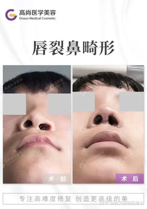 唇裂修复完能和正常人一样吗余文林解答