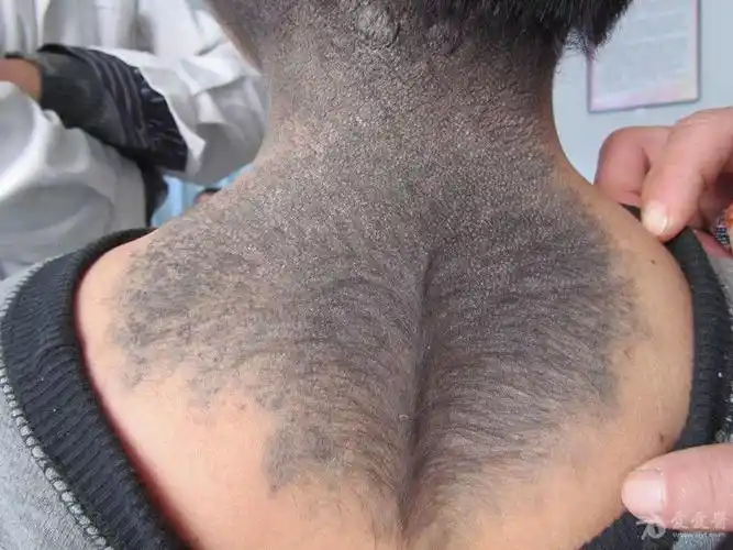 男孩颈,背部黑色斑——兽皮样痣