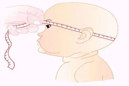 可有呕吐,嗜睡等症状 ,严重脑积水患儿头皮静脉扩张,眼球向下呈落日状