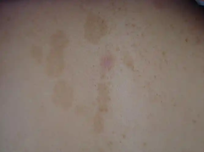 皮肤病色素沉着斑块求教