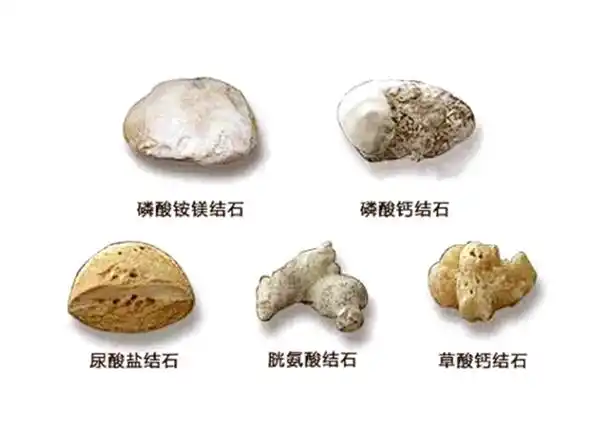 泌尿系统结石按成分主要分五大类,包括草酸钙结石,磷酸钙结石,胱氨酸