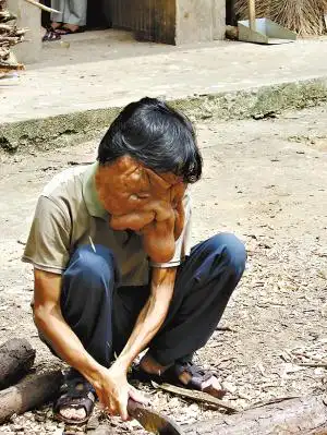 广东象面人换脸手术成功 切除瘤体重2.1斤(图)