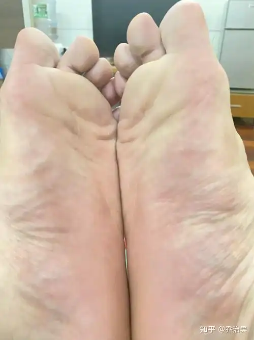 女生脚汗特别大咋办呀