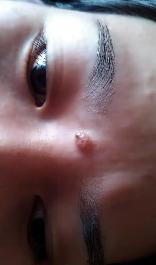 额头中间位置,右眉边上长了个肉痣(皮肤色).凸出皮肤表面.