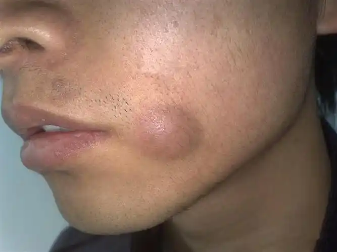 耳朵后边的皮脂腺囊肿图片